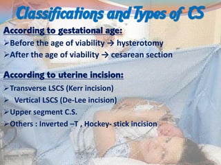 Cesarean section | PDF