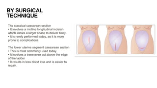 Cesarean Section pptx