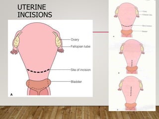 UTERINE
INCISIONS
 