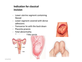 - Lower uterine segment containing
fibroid
- Lower segment covered with dense
adhesions
- Transverse lie with the back down
- Placenta praevia
- Fetal abnormality
- Carcinoma of the cervix
Indication for classical
incision
3/16/2024
 
