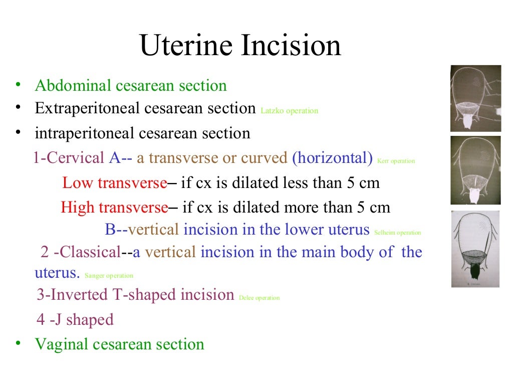 Cesarean Section Hennawy