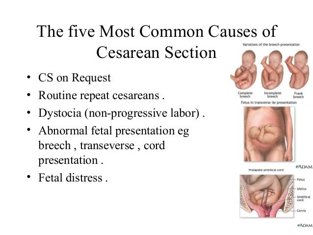 Cesarean section hennawy Cesarean section hennawy