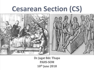 Dr. Jagat Bdr. Thapa
PAHS-SOM
10th June 2018
Cesarean Section (CS)
 