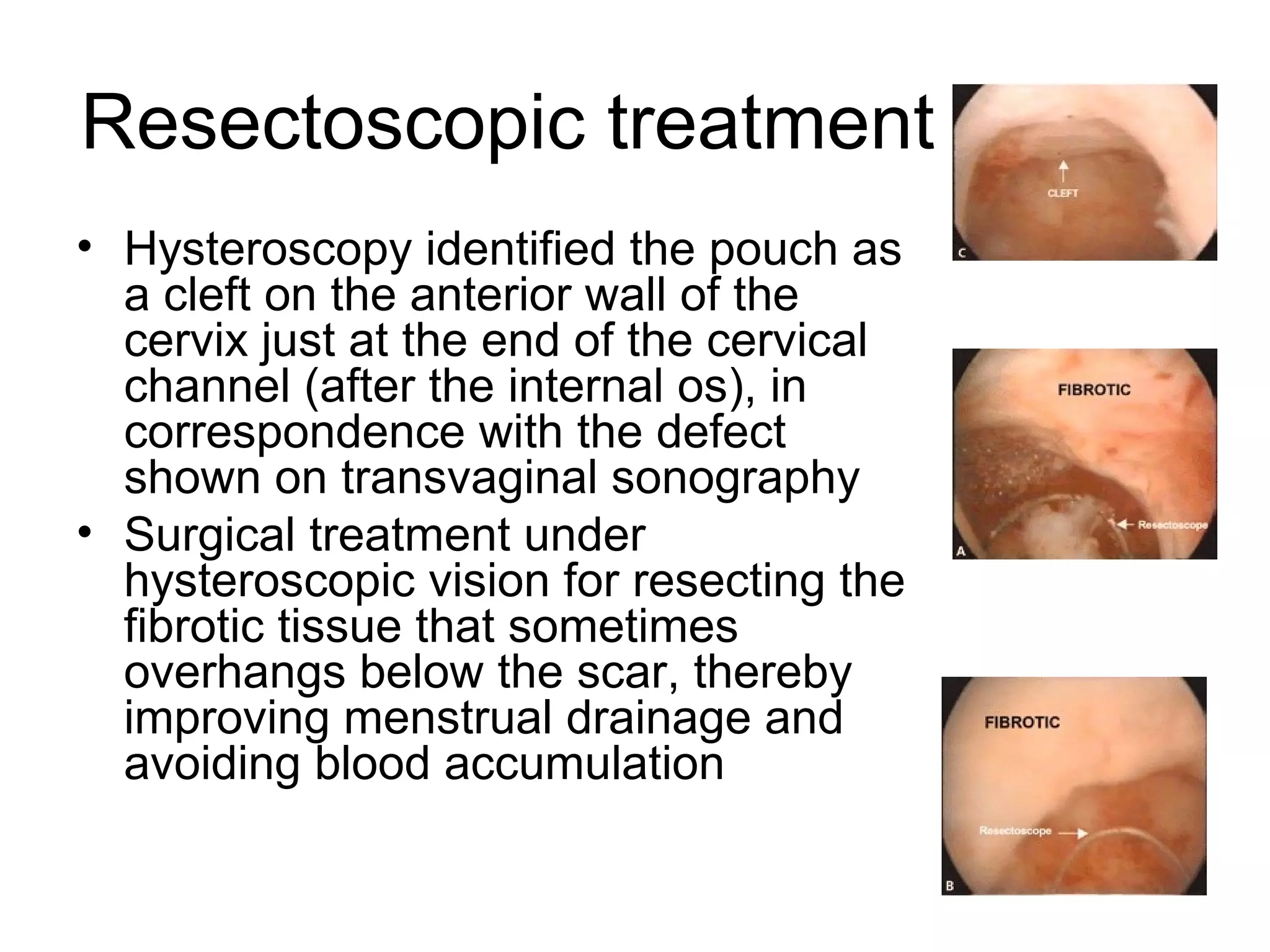 Cesareansectionscardefects | PPT