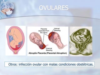  patologías sistémicas graves: insuficiencia respiratoria, insuficiencia cardiaca, HTA, glaucoma.hernias abdominales, inguinales grandes.Plastia vaginal previaMioma que obstruya canal cervical
