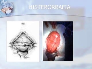SFA del periodo de dilatación o sin trabajo de parto.