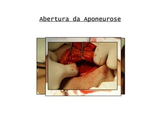 Abertura da Aponeurose 