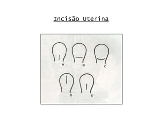 Incisão Uterina 