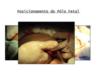 Posicionamento do Pólo Fetal   
