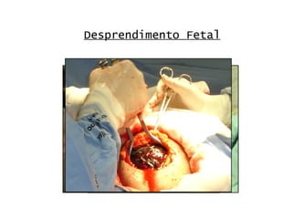 Desprendimento Fetal 