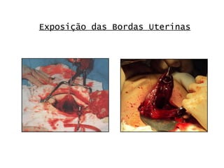 Exposição das Bordas Uterinas 