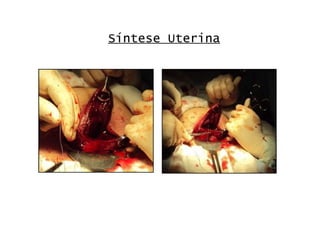 Síntese Uterina 