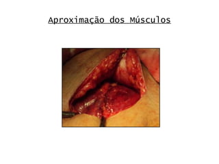 Aproximação dos Músculos 