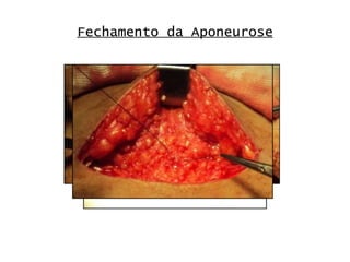 Fechamento da Aponeurose 