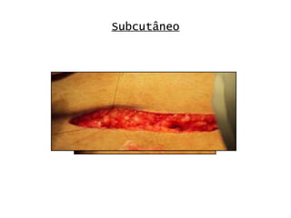 Subcutâneo 