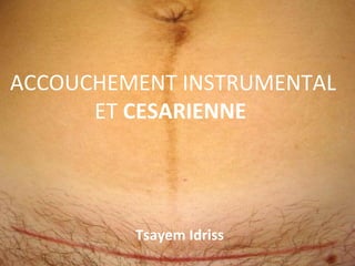 ACCOUCHEMENT INSTRUMENTAL
ET CESARIENNE
Tsayem Idriss
 