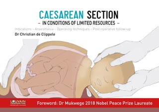 ↖ TABLE OF CONTENTS CAESAREAN SECTION IN CONDITIONS OF LIMITED RESOURCES 1
CAESAREAN SECTION
− IN CONDITIONS OF LIMITED RESOURCES −
Indications - Anaesthesia - Operating techniques - Post-operative follow-up
Dr Christian de Clippele
Foreword: Dr Mukwege 2018 Nobel Peace Prize Laureate
UNIVERSITAIRE & SOLIDAIRE
UNIVERSITAIRE & SOLIDAIRE
 