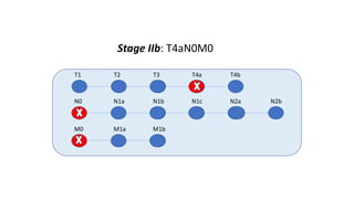 T1 T2 T3 T4a T4b
N0 N1a N1b N1c N2a N2b
M0 M1a M1b
Stage IIb: T4aN0M0
 