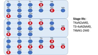 T1 T2 T3 T4a T4b
N0 N1a N1b N1c N2a N2b
M0 M1a M1b
T1 T2 T3 T4a T4b
N0 N1a N1b N1c N2a N2b
M0 M1a M1b
T1 T2 T3 T4a T4b
N0 N1a N1b N1c N2a N2b
M0 M1a M1b
Stage IIIc:
T4aN2aM0,
T3-4aN2bM0,
T4bN1-2M0
 