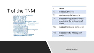 T of the TNM
T Depth
T1 Invades submucosa
T2 Invades muscularis propria
T3 Invades through the muscularis
propria into the pericolorectal
tissues
T4a Invades the visceral peritoneum
T4b Invades directly into adjacent
organs
AJCC TNM, 8th Ed, 2017
 