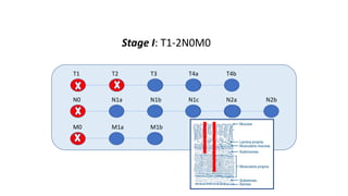 T1 T2 T3 T4a T4b
N0 N1a N1b N1c N2a N2b
M0 M1a M1b
Stage I: T1-2N0M0
 