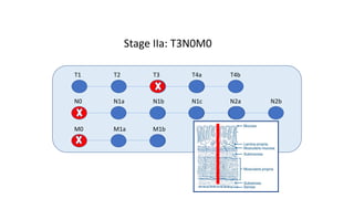 T1 T2 T3 T4a T4b
N0 N1a N1b N1c N2a N2b
M0 M1a M1b
Stage IIa: T3N0M0
 
