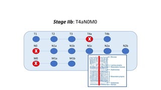 T1 T2 T3 T4a T4b
N0 N1a N1b N1c N2a N2b
M0 M1a M1b
Stage IIb: T4aN0M0
 