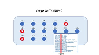 T1 T2 T3 T4a T4b
N0 N1a N1b N1c N2a N2b
M0 M1a M1b
Stage IIc: T4cN0M0
órgano
 