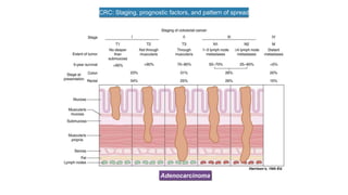 CRC: Staging, prognostic factors, and pattern of spread
Harrison’s, 19th Ed.
Adenocarcinoma
 