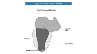 Stage II / III rectal cancer: Treatment
 