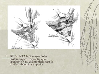 DESVENTAJAS: mayor dolor postquirúrgico, mayor tiempo operatorio y no es apropiada para la cavidad abdominal superior 