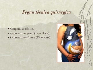 Según técnica quirúrgica •  Corporal o clásica. •  Segmento corporal (Tipo Beck). •  Segmento arciforme (Tipo Kerr) 