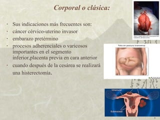 Corporal o clásica: Sus indicaciones más frecuentes son:  cáncer cérvico-uterino invasor  embarazo pretérmino procesos  adherenciales o varicosos importantes en el segmento inferior, placenta previa en cara anterior cuando después de la cesárea se realizará una histerectomía . 