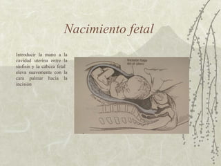 Nacimiento fetal  Introducir la mano a la cavidad uterina entre la sínfisis y la cabeza fetal  eleva suavemente con la cara palmar hacia la incisión  