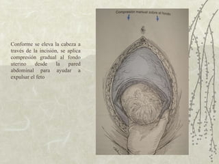 Conforme se eleva la cabeza a través de la incisión, se aplica compresión gradual al fondo uterino desde la pared abdominal para ayudar a expulsar el feto  
