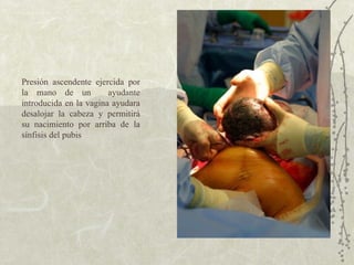 Presión ascendente ejercida por la mano de un  ayudante introducida en la vagina ayudara desalojar la cabeza y permitirá su nacimiento por arriba de la sínfisis del pubis 