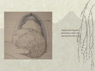 Aspiración liquido amniótico antes del nacimiento del tórax  