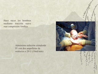 Hace nacer los hombros mediante tracción suave mas compresión fundica  Administra solución cristaloide IV con dos ampolletas de oxitócica o 20 U (10ml/min) 