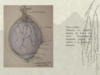 Pinza cordón  Observa la incisión uterina en busca de sitios hemorrágicos mediante pinzas de anillos y se extrae la placenta  