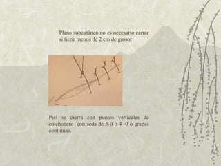 Plano subcutáneo no es necesario cerrar si tiene menos de 2 cm de grosor  Piel se cierra con puntos verticales de colchonero  con seda de 3-0 o 4 -0 o grapas continuas. 