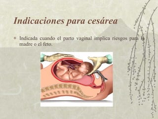 Indicaciones para cesárea Indicada cuando el parto vaginal implica riesgos para la madre o el feto. 