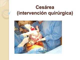 Cesárea
(intervención quirúrgica)
 