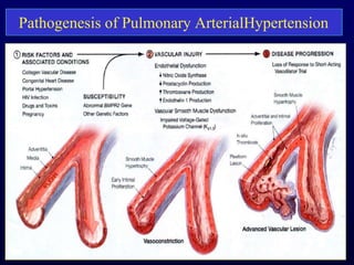 Pathogenesis of Pulmonary ArterialHypertension
 