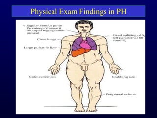 Physical Exam Findings in PH
 
