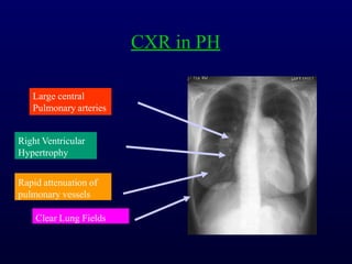 CXR in PH
Large central
Pulmonary arteries
Right Ventricular
Hypertrophy
Rapid attenuation of
pulmonary vessels
Clear Lung Fields
 