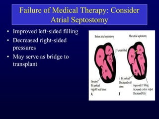 Failure of Medical Therapy: Consider
Atrial Septostomy
• Improved left-sided filling
• Decreased right-sided
pressures
• May serve as bridge to
transplant
 