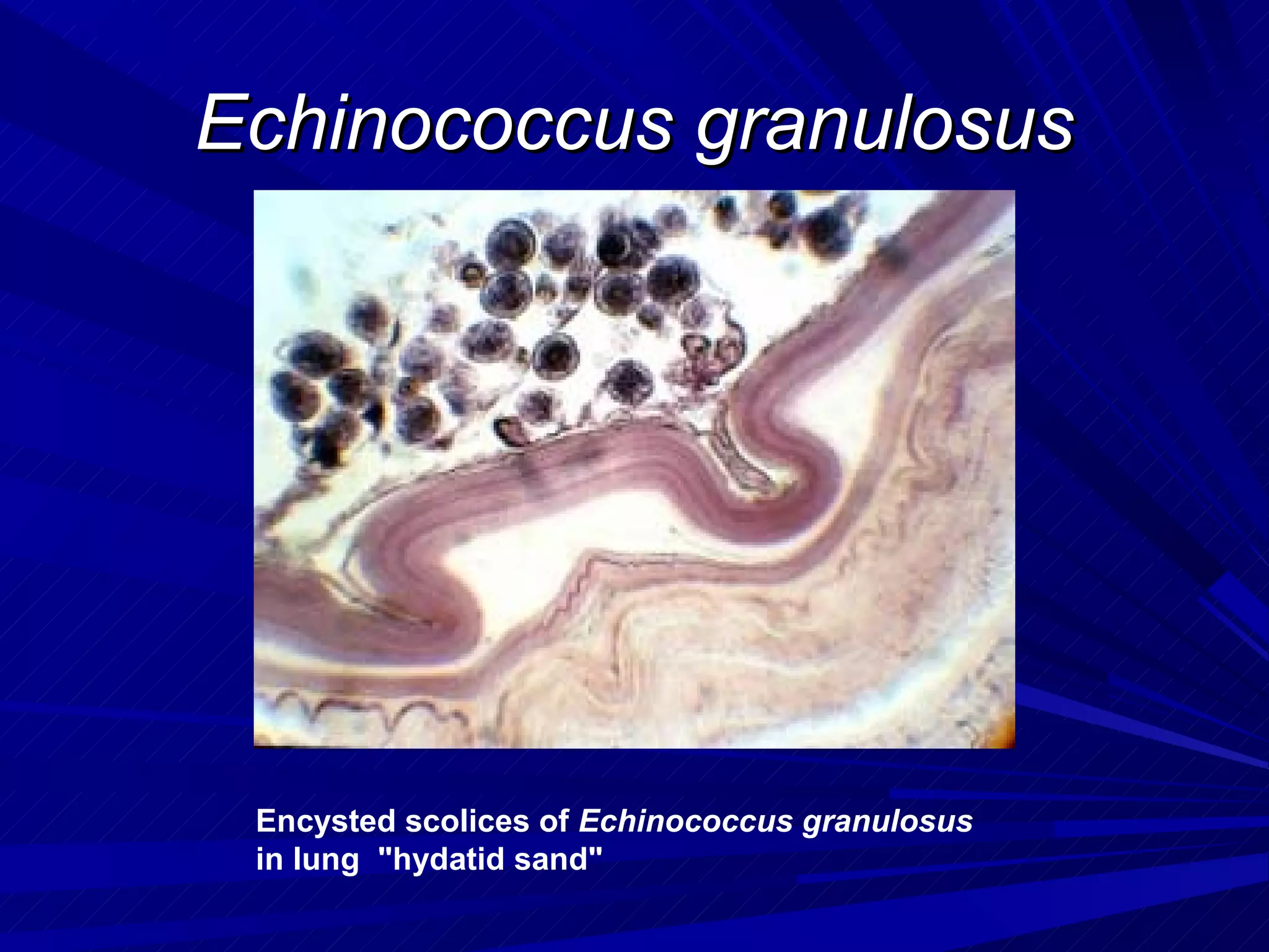 Echinococcus granulosus




 Encysted scolices of Echinococcus granulosus
 in lung "hydatid sand"
 