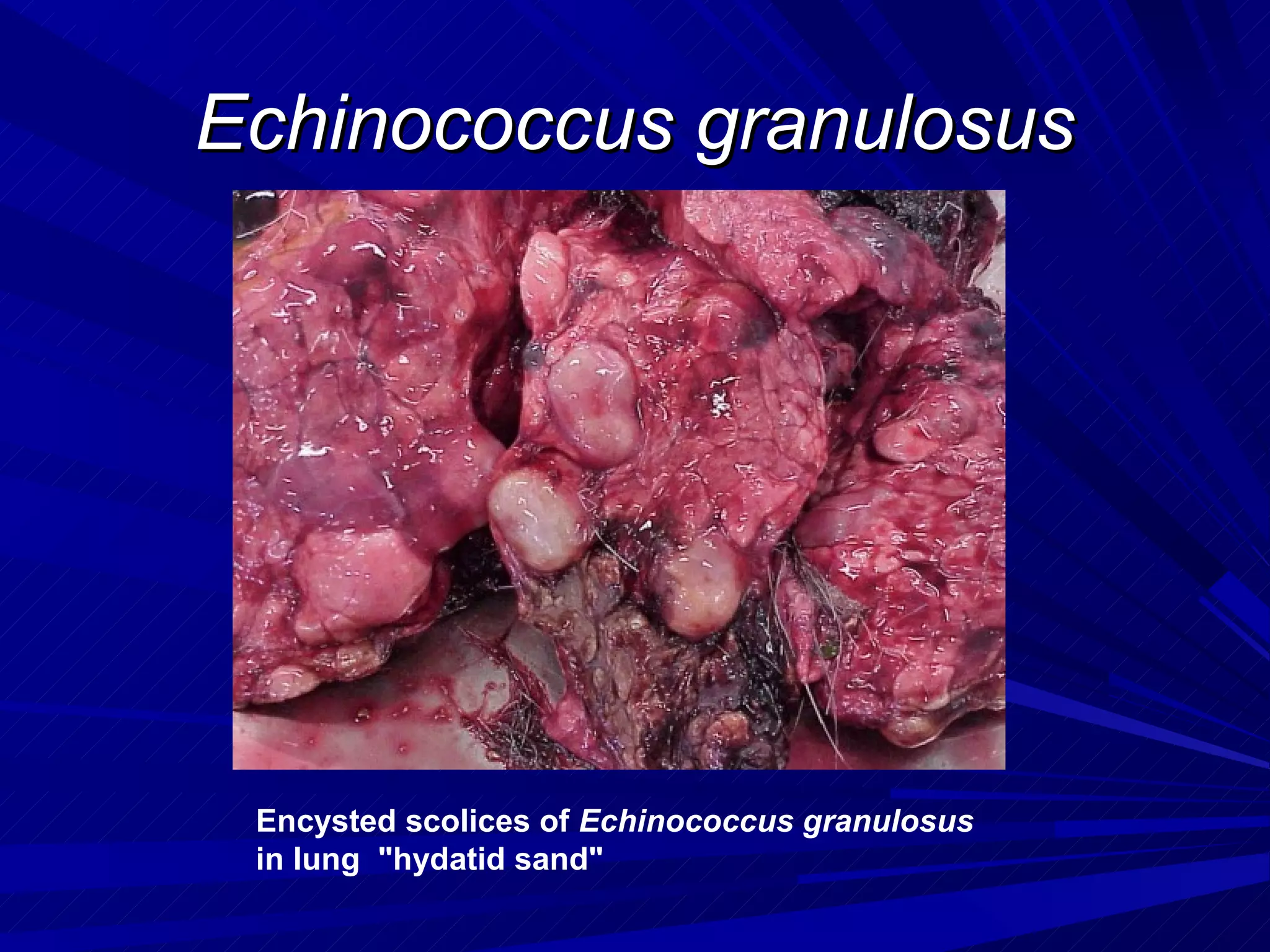 Echinococcus granulosus




 Encysted scolices of Echinococcus granulosus
 in lung "hydatid sand"
 