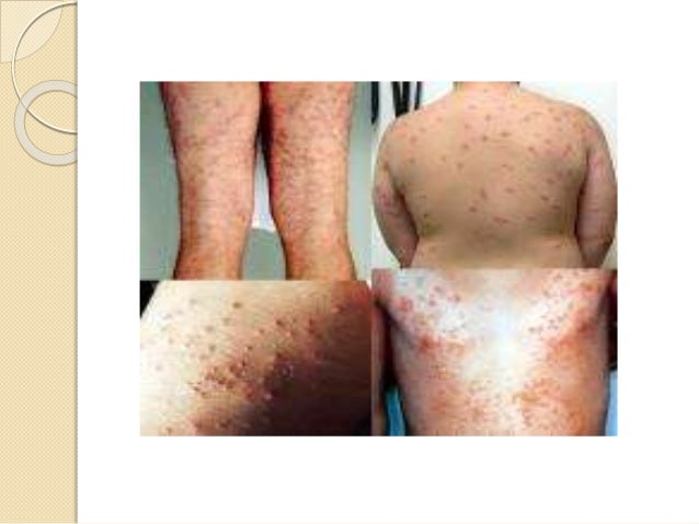 Yeast Infection Skin Rash Causes ... - eMedicineHealth