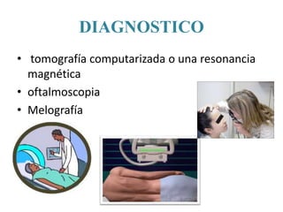 DIAGNOSTICO
• tomografía computarizada o una resonancia
magnética
• oftalmoscopia
• Melografía
 